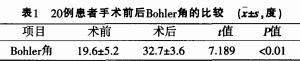 经皮骨圆针撬拨复位石膏外固定治疗跟骨骨折2O例小结